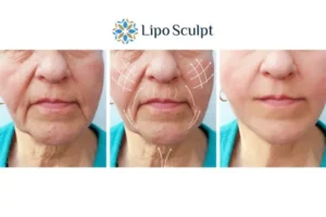 Explaining Morpheus8 And What It Can Do For You 3 Boost your confidence with Morpheus8 Bridgwater call our team today!