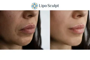 Explaining Morpheus8 And What It Can Do For You 4 Morpheus8 Bridgwater the best results - call our team today!