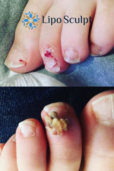 Wart removal customer results from Lipo Sculpt Bridgwater